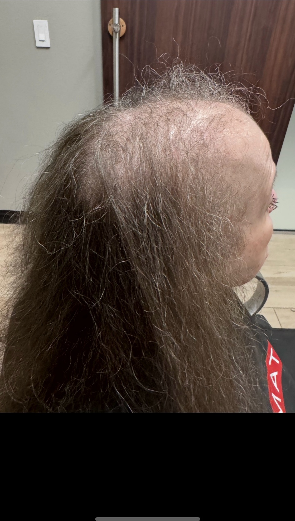 Before mesh integration system showing thinning crown and hair loss